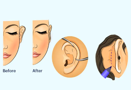 Otoplasty (Ear Surgery)