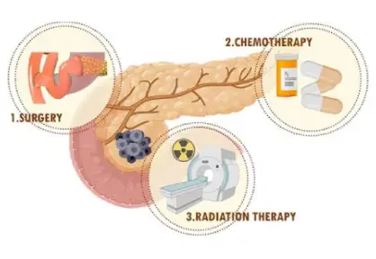 Pancreatic Cancer Treatment