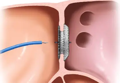 Pediatric ASD/VSD Repair