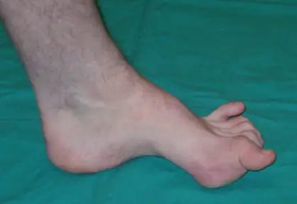 Pediatric Foot Deformities Treatment
