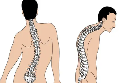 Pediatric Scoliosis and Kyphosis Surgery