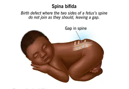 Pediatric Spina Bifida Surgery
