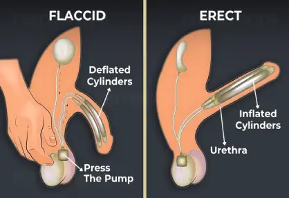 Penile Implant Surgery (Penile Prosthesis)