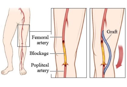 Peripheral Artery Bypass Surgery