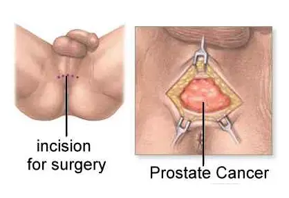Prostate Cancer / Prostatectomy