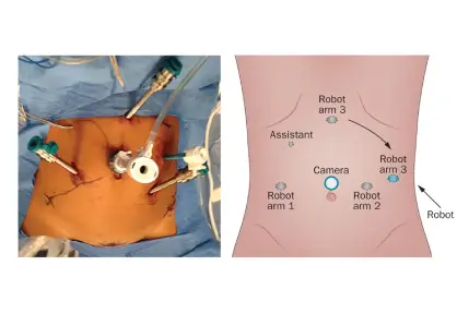 Rectal Cancer Surgery
