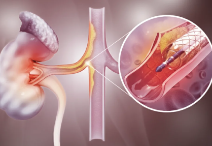 Renal Artery Angioplasty and Stenting