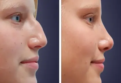 Rhinoplasty