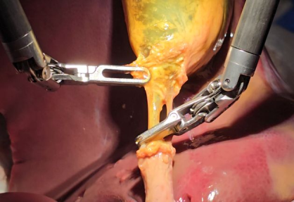 Robotic Cholecystectomy (Gallbladder Removal)