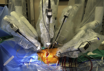 Robotic Coronary Artery Bypass Grafting (CABG)