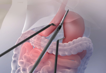 Robotic Sleeve Gastrectomy