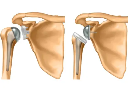 Shoulder Replacement Surgery