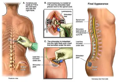 Spinal Cord Stimulator Implant Surgery