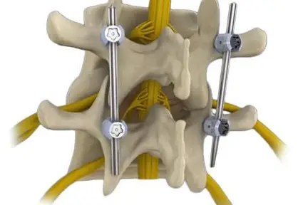 Spinal Decompression and Fixation Surgery