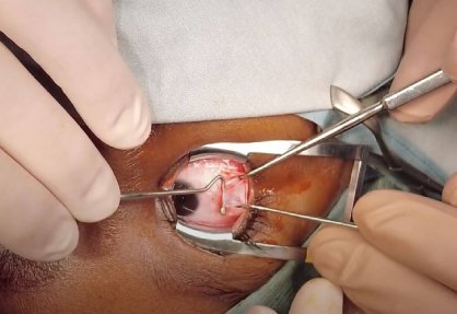 Squint Surgery in India
