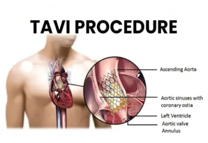 TAVI / TAVR (Transcatheter Aortic Valve)