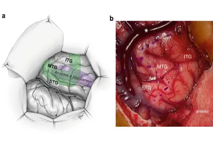 Craniotomy for Epilepsy / Temporal Lobectomy