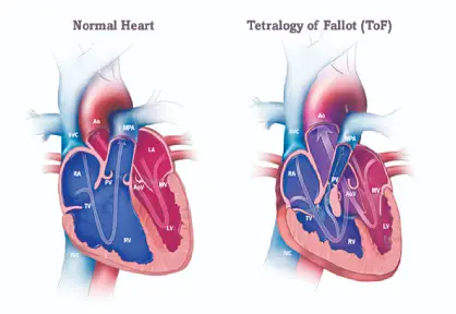 Tetralogy of Fallot (TOF) Repair