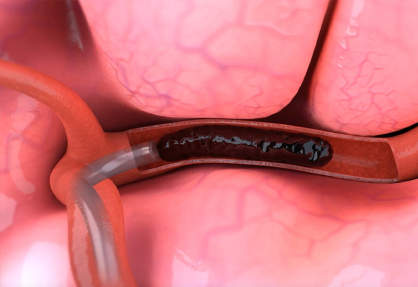Thrombectomy
