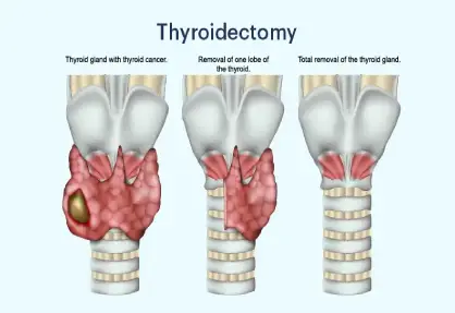 Thyroidectomy (Total/Partial)