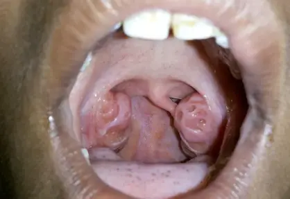 Tonsillectomy