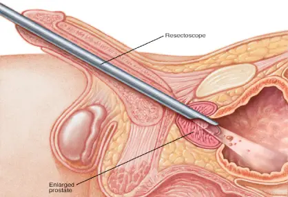 TURP (Transurethral Resection of the Prostate)