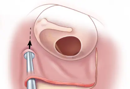 Tympanoplasty / Ear Drum Surgery