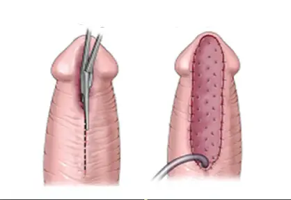 Urethroplasty