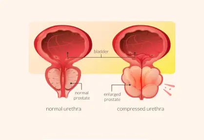 UroLift Procedure (Prostatic Urethral Lift)