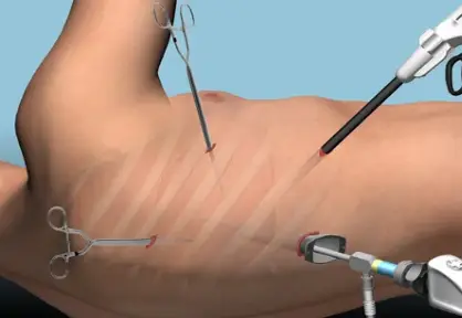 VATS Lung Surgery