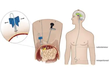 VP Shunt Surgery (Ventriculoperitoneal Shunt)