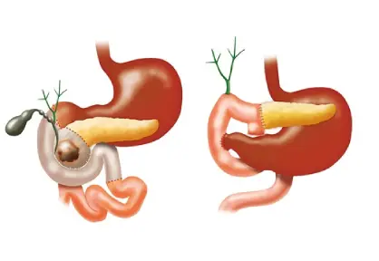 Whipple Surgery